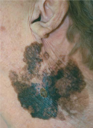 Types of Melanoma 70% not always sun damaged skin flat,