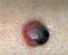 JAMA 2004 Surgical Management and Sentinel Lymph Node Biopsy in Cutaneous Melanoma Diagnostic Biopsy in Primary Melanoma Goals Rule out lesions