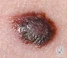 invasion Identify other prognostic features of the 1º lesion Narrow excisional biopsy (2-3 mm) Am J Clin Dermatol. 2002;3:401-426. 426.