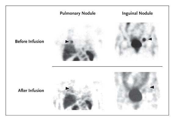 Treatment of Metastatic Melanoma with Autologous CD4+ T cells against NY-ESO-1 Yee et al., June 19, 2008 NEJM 52yo wm with recurrent melanoma and pulmonary, left iliac and inguinal metastases.