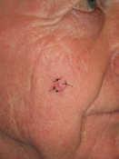 Merkel Cell Carcinoma Rare and aggressive neuroendocrine carcinoma Account for < 1% all skin tumors SEER data 1986-2001 identified 1124 cases > 70yo 50% H and N M = F UV plays role Higher mortality