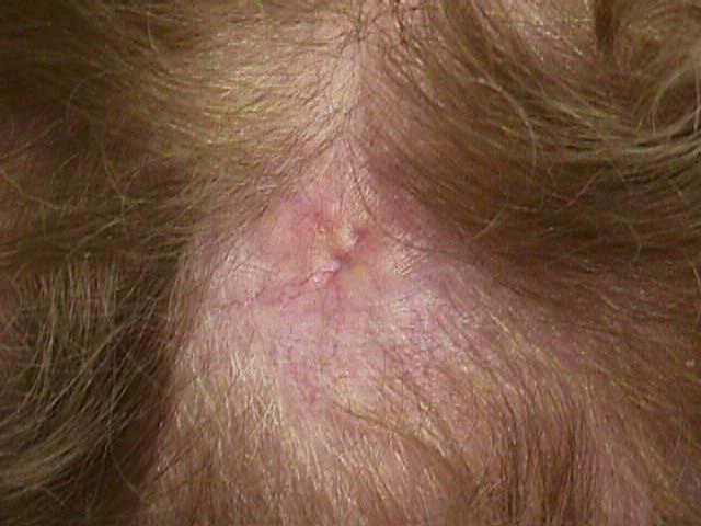 70 yo woman presented with a scar-like lesion, no antecedent trauma Question 1. Merkel cell carcinoma 2. Basal cell carcinoma 3. Metastatic tumor 4. Squamous cell carcinoma 5.