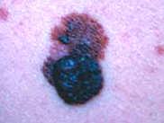 melanomas Mortality from melanoma continues to rise