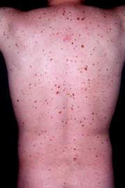 Risk Factors * RR PEOPLE AT HIGH RISK OF MELANOMA Fair skin 2-18 Freckles 3-20 Blonde hair 2-10 Red hair 2-6 Inability to tan 2-5 Blue eyes 2-5 Constant Sun 2-5 Intermittent Sun 2-3 Immunosupp 2-8
