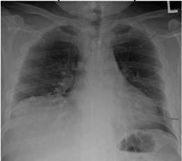 Fitzgerald Health Education Associates 143 Chest Pain After Being Hit with a Bat An 11-year-old male with a chief complaint of left sided chest pain presented to the ED after sustaining a blow to the