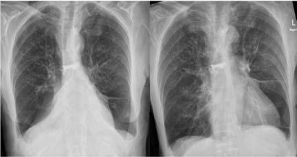 Reference Slides Other Common Abnormalities Fitzgerald Health Education Associates 197 Atelectasis Condition of volume loss in some portion of lung May involve sub-segment, segment, lobe or entire