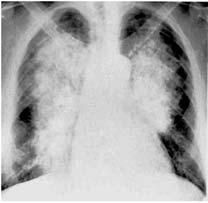 Pulmonary Edema Peribronchial cuffing Bat wing" pattern Perihilar and medullary consolidation of both lungs Patchy shadowing with