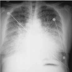 Heart Failure Pleural Effusion Source: Anthony Angelow Causes CHF Infection