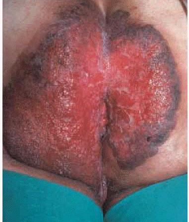 EXTRAMAMMARY PAGET S DISEASE Perianal Sharply demarcated
