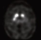 Abnormal: Abnormal DaTscan images fall into at least one of the following three categories (all are considered abnormal). Activity is asymmetric, e.g. activity in the region of the putamen of one hemisphere is absent or greatly reduced with respect to the other.