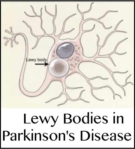 Future directions for Lewy body dementia: Aimed at underlying