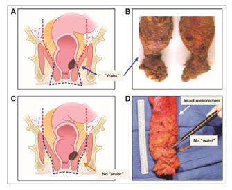 The anatomic considerations for extra-levator abdominoperineal excision (ELAPE) are shown J