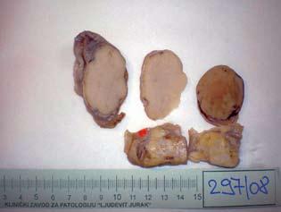 mal in size and appearance. The tumor was sent for frozen section analysis, where it was suspected to be a granulosa cell tumor.