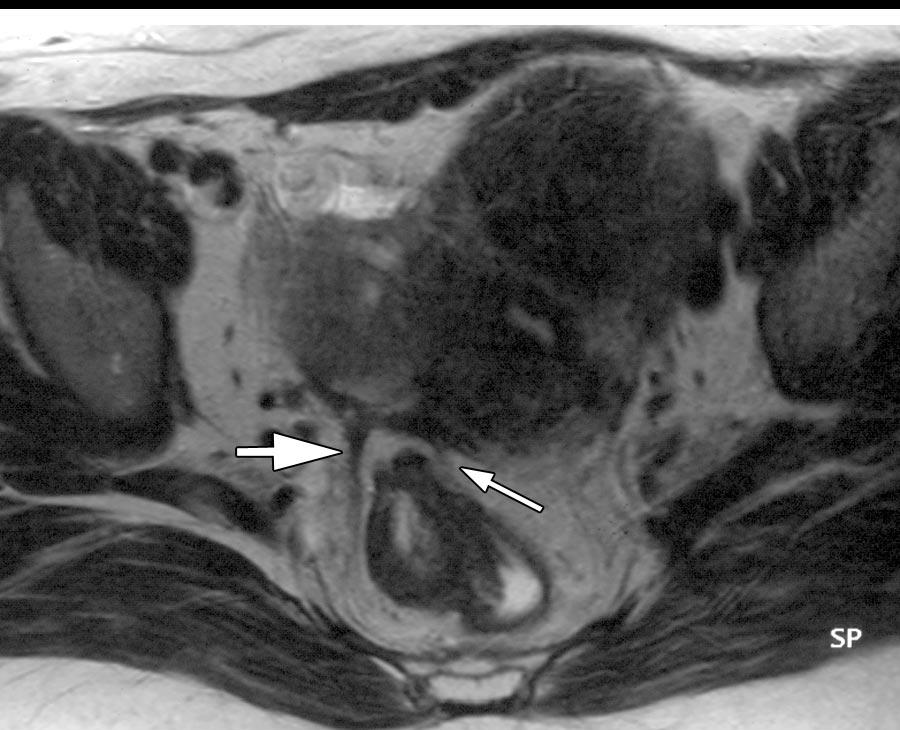Truepositive diagnosis of torus uterinus and bilateral USL involvement with endometriosis, along with rectal involvement, was determined at MR imaging. Figure 2.