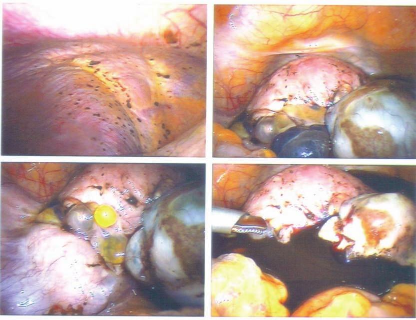 The Obstetrician & Gynaecologist 2011;13:1 6 Review Figure 2 Laparoscopic images of endometriotic ovarian cysts with widespread endometriosis histology confirms the diagnosis, but negative histology
