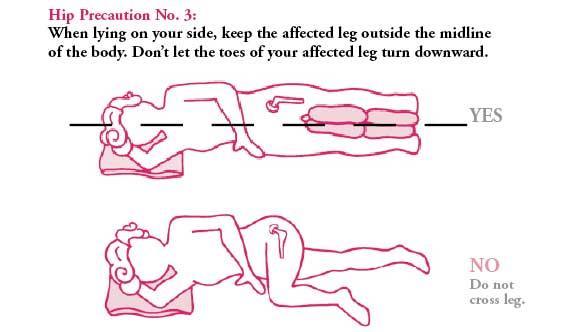 Mobility: Patient Positioning After hip arthroplasty (posterior approach) Patient usually positioned supine in bed Affected extremity held in slight abduction by an abduction splint