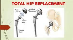 Total hip replacement versus hemiarthroplasty A hip