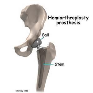 half of the hip joint is replaced.