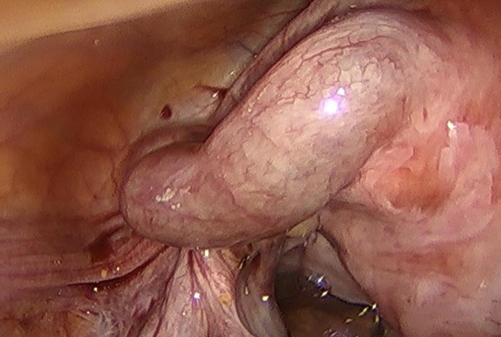Transmural or mucosal involvement less common
