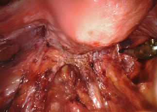49. Year old female with rectal bleeding and failed medical management