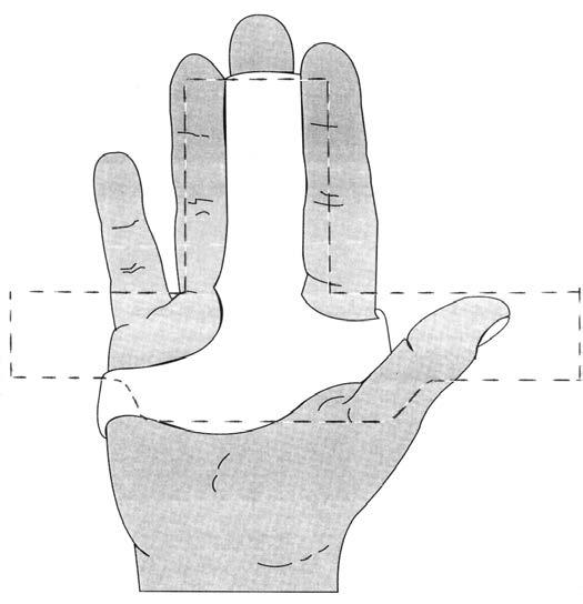 The long part of the L needs to be sufficiently long to wrap onto the dorsum of the hand. Mould and create a dorsal weld along the 2 nd or 5 th finger.