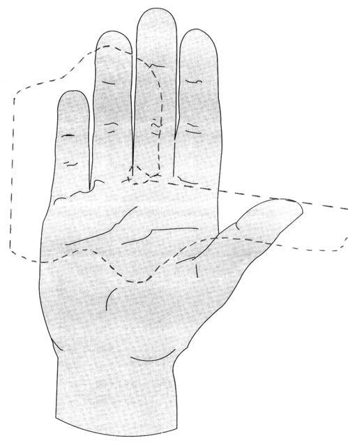 Example indications: As per above Procedure: Cut a wide T shape where the stem of the T is approximately 1.5 times the length of the finger and the width is equal to the finger circumference plus 1cm.