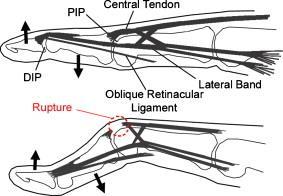 Boutonniere Deformity Injury Mechanism: Middle phalanx flexes on proximal phalanx @ the PIP joint