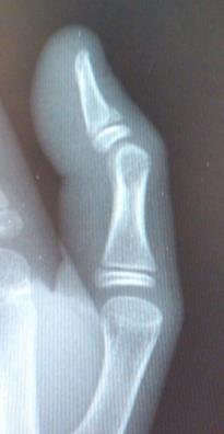 Radiology-Mallet Finger X-ray views AP, Lateral & Oblique finger Soft tissue Mallet finger negative x-ray Boney Mallet Finger Size bone fx/avulsion variable >50% joint