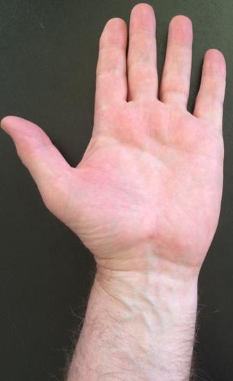 Zones of the Palmar Hand: Zone I: Distal to FDS insertion Zone II: FDS insertion to midpalmar crease Tendon laceration & NV injury Zone III: Palm-distal palmar crease to