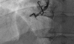 vessel Fully occluded vessel is the best option for patients with moderate thrombus burden (Grades