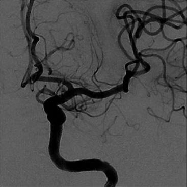 When the subsequent control angiography showed a TICI grade <2, clot aspiration with the reperfusion catheter was reattempted until a TICI grade of 2b was reached (Fig. 1).