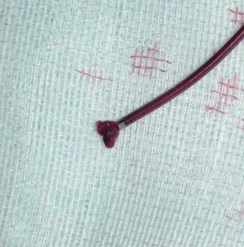 The Solitaire stent, which was 4 mm in diameter and 20 mm long or 6 mm in diameter and 30 mm long was then introduced through the microcatheter and fully deployed across the occluded segment.