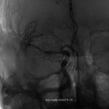 When the subsequent control angiography showed a TICI grade <2, clot retrieval with the Solitaire stent was reattempted until a TICI grade of 2b was reached or until three passes (Fig. 2).