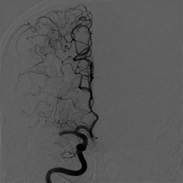 patients were caused by proximal middle large artery or distal internal carotid artery occlusion (56 patients caused by vertebrobasilar artery or proximal common carotid artery occlusion were