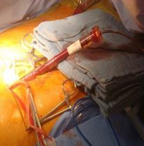 inflated before venous cannula placement to prevent dislodgement Arterial Cannulation EndoReturn Cannula Sizes: 21 Fr & 23 Fr