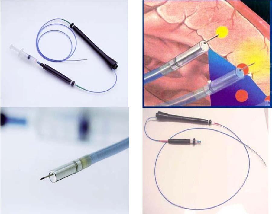 3. Endocardial Route Device and method : stem cell injection directly into the myocardium with a catheter navigated in the LV by fluoroscopic guidance or electroanatomic mapping BioCardia Helical
