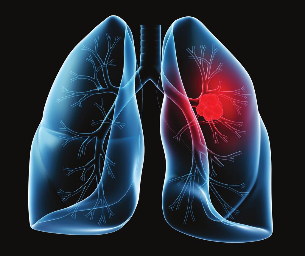 California Thoracic Society 2014 Fall Symposium Advances in Lung Cancer: Screening, Diagnosis, Staging & Treatment A Course for Physicians, Surgeons and Nurses Sunday Workshop: EBUS,