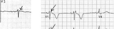 Small negative deflection just beyond the QRS in V 1 or V 2 (figure 7)