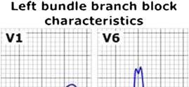 Left bundle branch block: QRS >0.