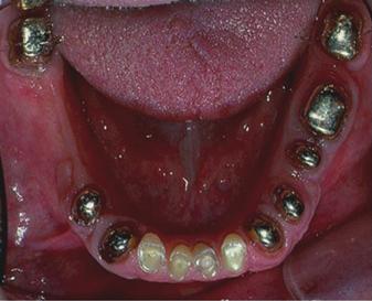 Figure 2 Pretreatment partially edentulous mandible.