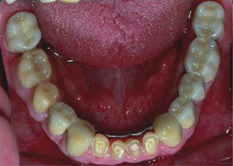 In many cases, otherwise hopeless or compromised teeth can be retained (Figs 2 5, 9). 5. Bilateral splinting: A.