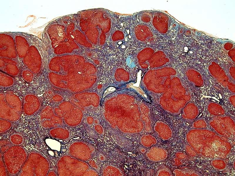 Cirrhosis: A lesion composed of nodules, separated by parenchymal
