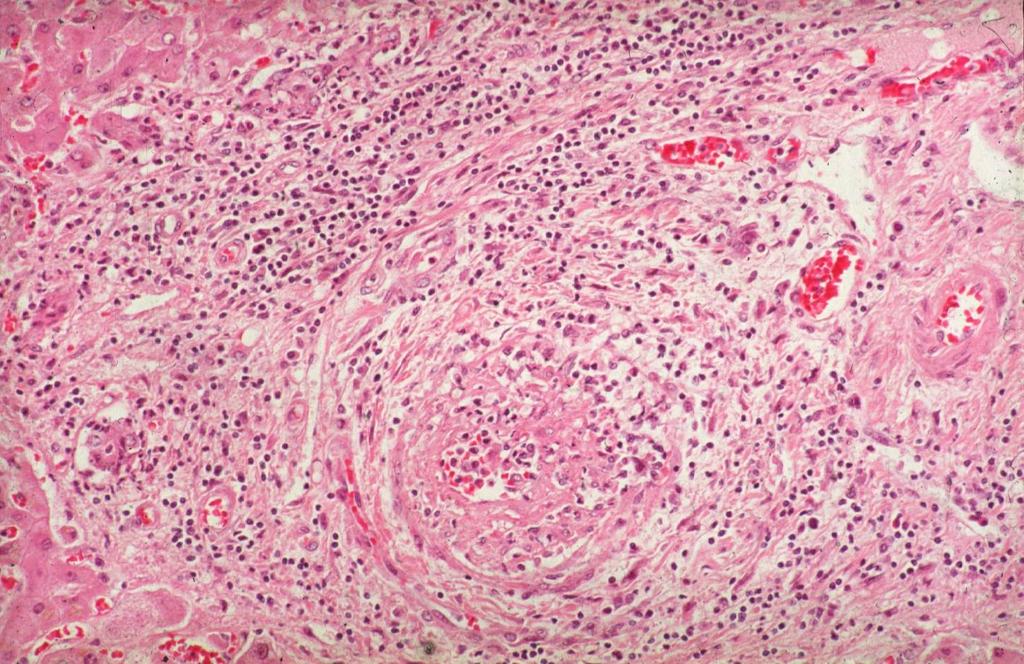 Polyarteritis nodosa Ménage à foie: injury to adjacent portal tract