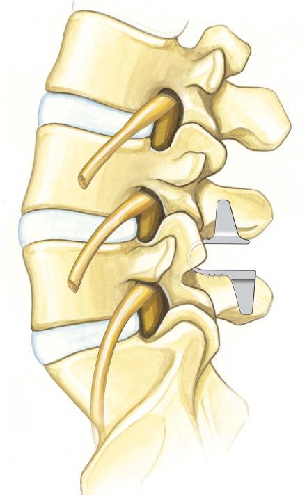 Vertebral Body Spinous Processes Intervertebral Disc coflex Nerve Figure 2: coflex implanted in the spine WHAT IS SPINAL STENOSIS? Spinal stenosis is a narrowing of the spinal canal.