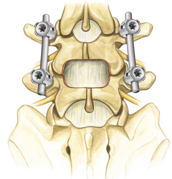o Direct decompression and spinal fusion. In spinal fusion, your doctor puts some of your bone (bone graft) between two bones in the area of the decompression surgery.