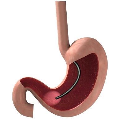 Oesophagus Stomach Gastroscope Duodenum Why do I need to have a gastroscopy?
