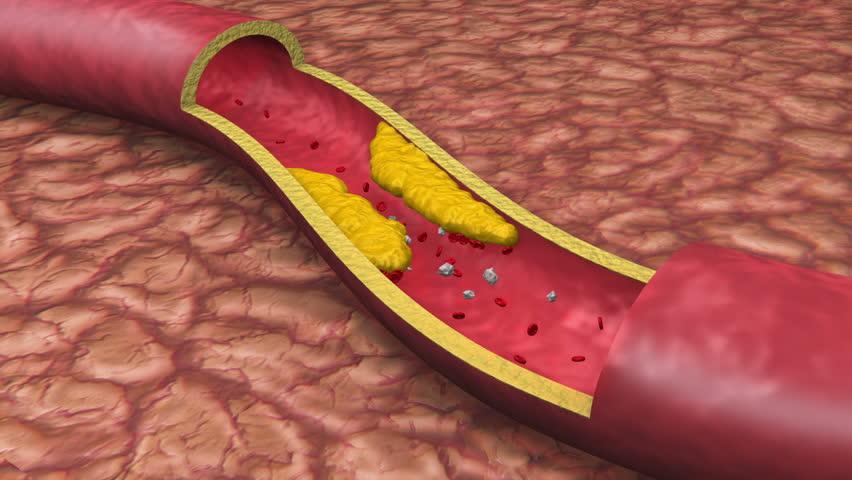 A Diet High in Saturated Fat Negatively affects circulation Constricts arteries Increases blood