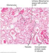 Glomerulonephritis: Nephritic Syndromes There are two types of Nephritic syndromes 1.