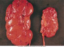, LWW, 2014 Acute Chronic Chronic pyelonephritis Persistent or recurring episodes of acute pyelonephritis that lead to scarring Reflux nephropathy (most frequent cause, especially in children)