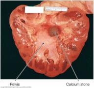 Urolithiasis (Kidney Stones) Kidney stones - Calculi or urinary stones Urolithiasis stones in the urinary tract Masses of crystals, protein, or other substances that form within and may obstruct the